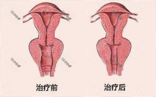 女性阴道紧缩手术前后对比动画图.png 女性阴道紧缩手术前后对比动画图.png