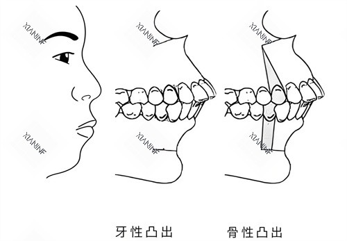 牙性突出和骨性突出对比图.jpg