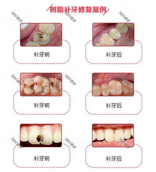 树脂补牙修复实例.jpg 树脂补牙修复实例.jpg