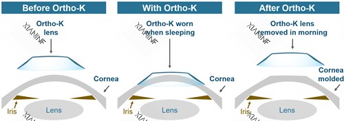 OK镜改善眼睛角膜的弧度.jpg
