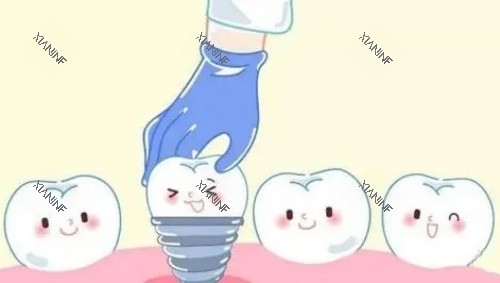 单颗牙齿种植示意图.jpg