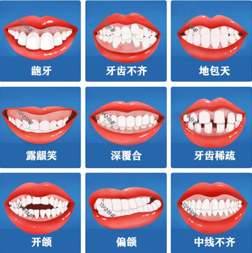 牙齿矫正适应症.jpg
