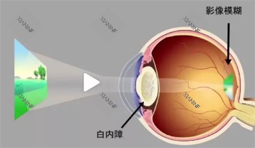 白内障成像.jpg