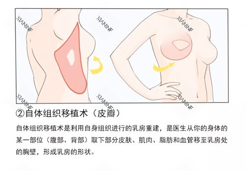 乳房重建手术卡通图.jpg
