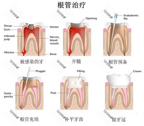牙齿根管治疗过程图.jpg