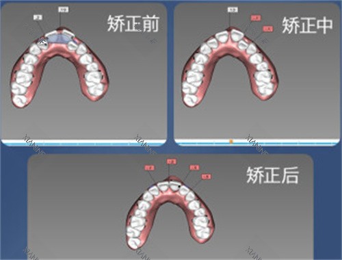 牙齿矫正设计图.jpg