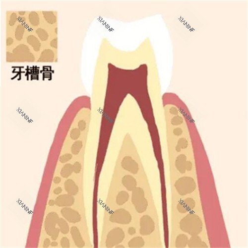 牙槽骨缺失卡通图.jpg