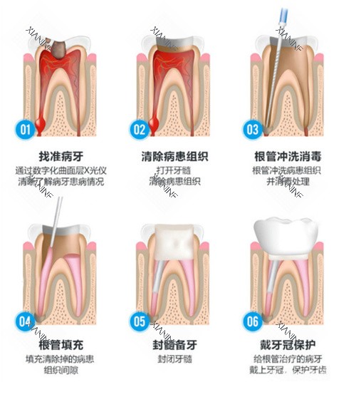 根管治疗流程示意图.jpg
