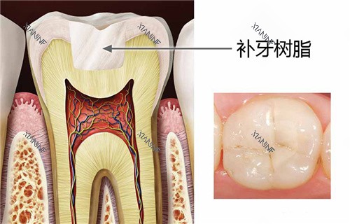 补牙树脂结果图.jpg
