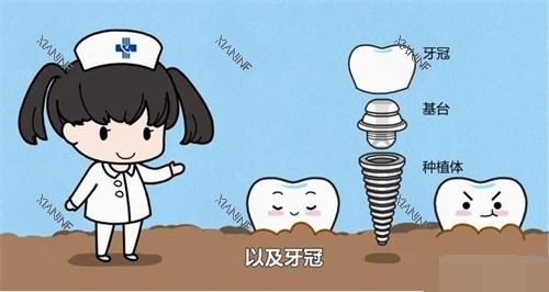 护士讲解种植牙结构漫画图.jpg