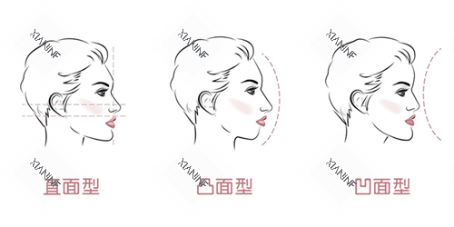 牙齿矫正面型问题.png