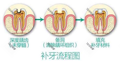 补牙流程图示意图.jpg