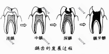 龋齿的发展过程示意图.jpg