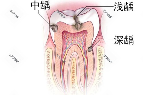 牙齿龋齿深浅图.jpg