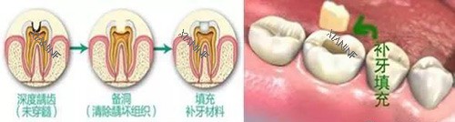 补牙过程展示.jpg