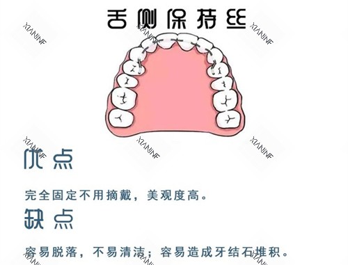 牙齿矫正舌侧保持器优缺点图.jpg