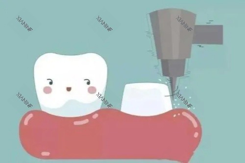 牙齿打桩卡通图.jpg