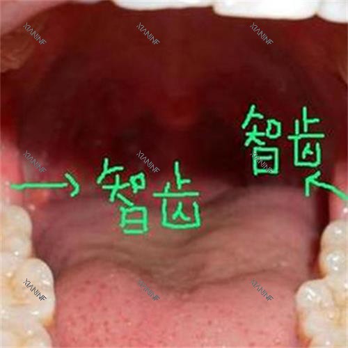 牙齿智齿所在位置.jpg