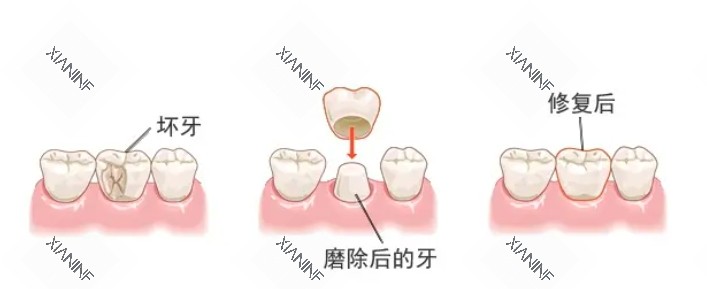 牙冠修复演示图.png