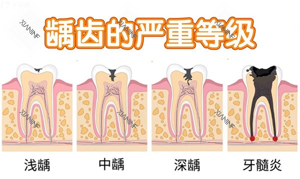 坏牙的程度.jpg