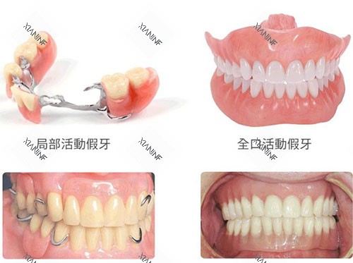 局部活动假牙和全口活动假牙示意图.jpg