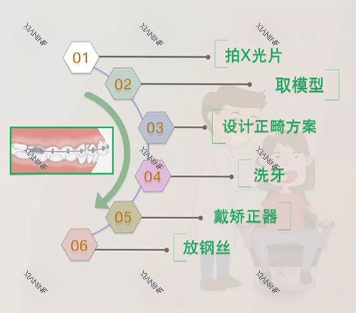 牙齿矫正流程.jpg
